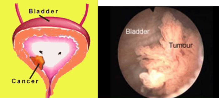 Bladder