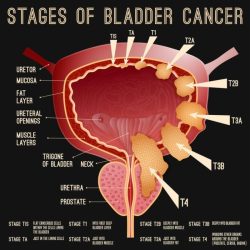 Do i have bladder cancer quiz